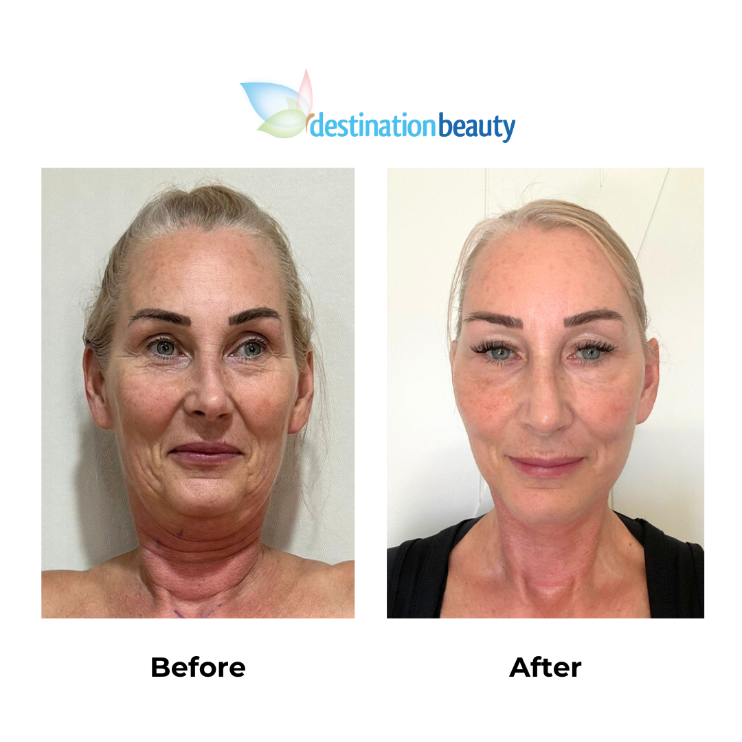 Julie had facelift surgery in Thailand